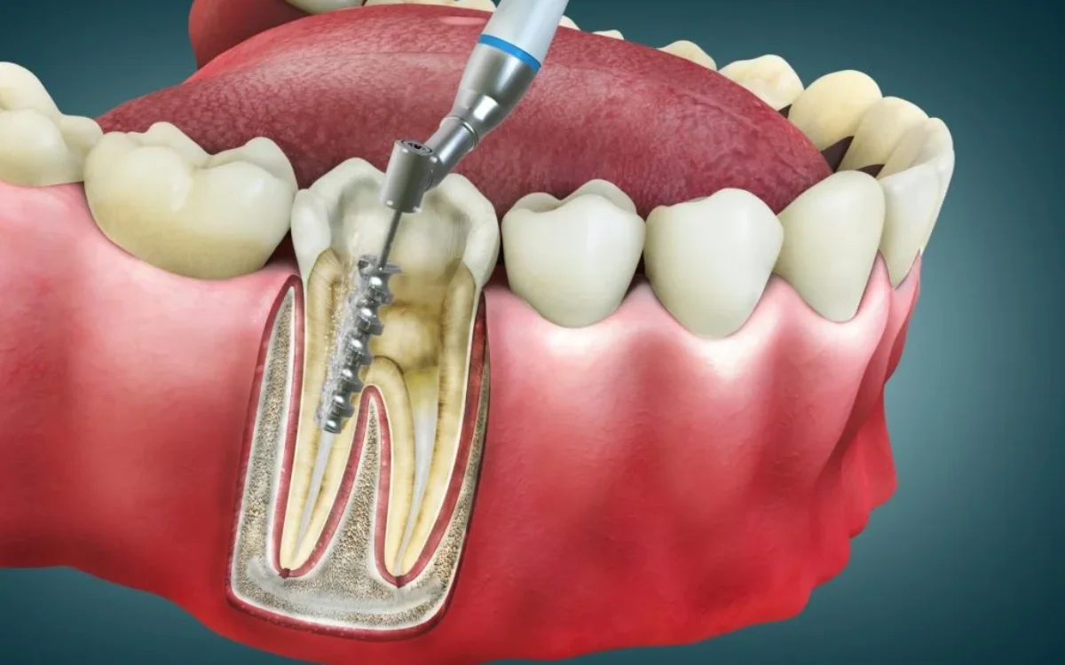 Root Canal Treatment (RCT) at Keluarga Dental Smile, Sentul Kuala Lumpur